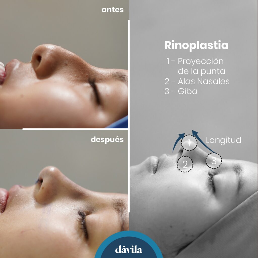 cuánto cuesta una rinoplastia