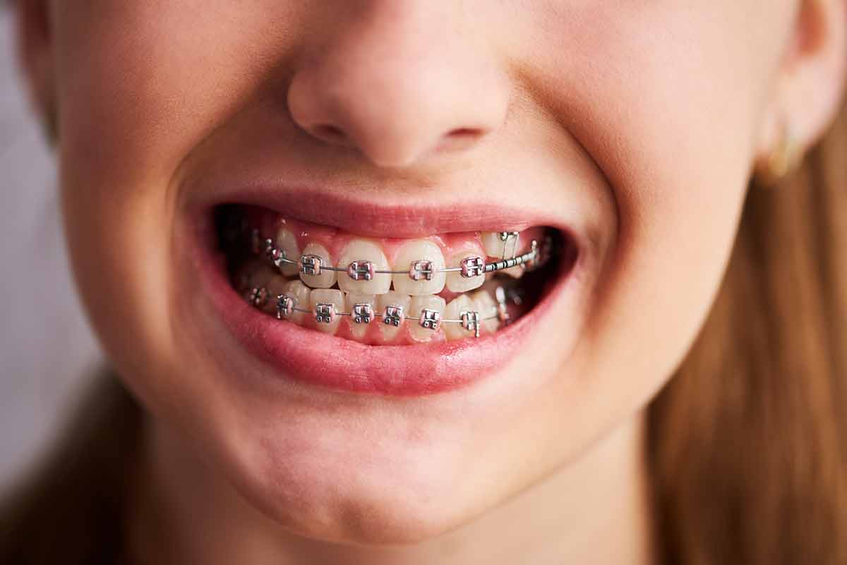 Thumbnail for ¿Cuánto Cuesta Tener una Sonrisa Perfecta?